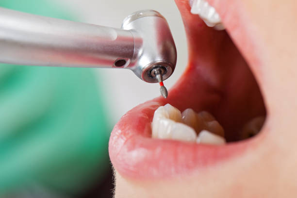 Best Emergency Dental Care for Broken or Chipped Teeth in Rockville, IN